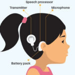 Cochlear_Implant_big-496x379_big-527x400